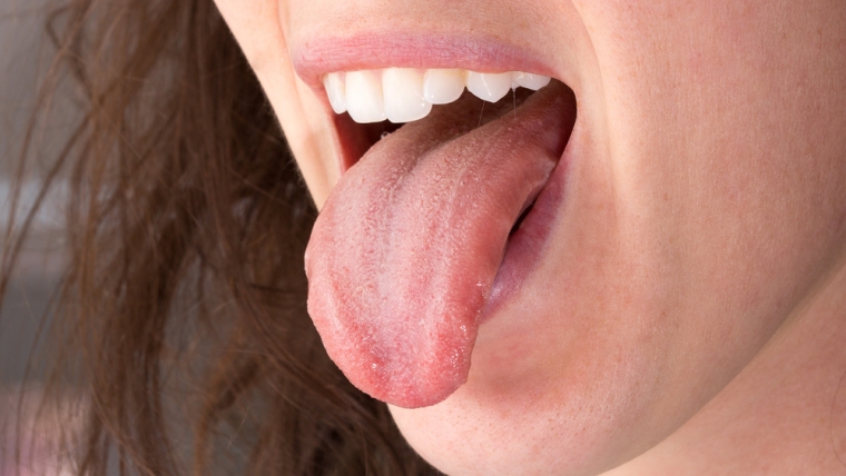 ¿Cuáles son las enfermedades linguales más comunes?