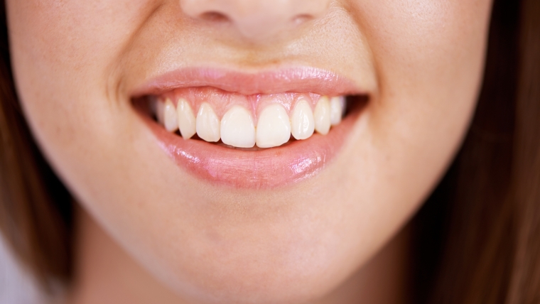 Sonrisa gingival: ¿Qué es y cómo es su tratamiento?