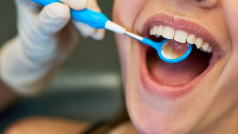 Todo lo que debes saber sobre la fluorización dental y por qué es importante