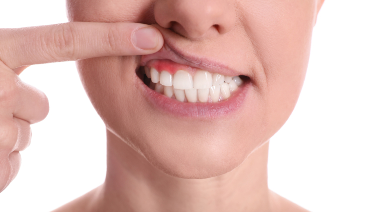 Síntomas comunes de la periodontitis: cuándo consultar a un dentista