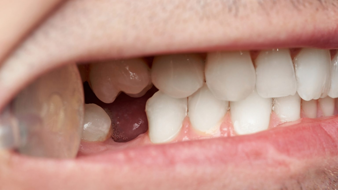 Agenesia Dental: ¿qué es y cuáles son sus soluciones?
