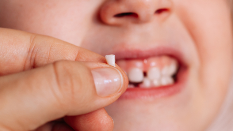 ¿Qué hacer si hay una pérdida prematura de los dientes de leche?