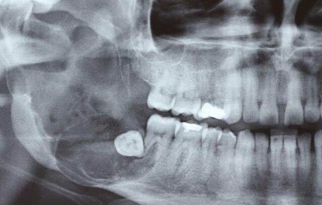 Tumores odontogénicos: cuando los dientes salen donde no deben