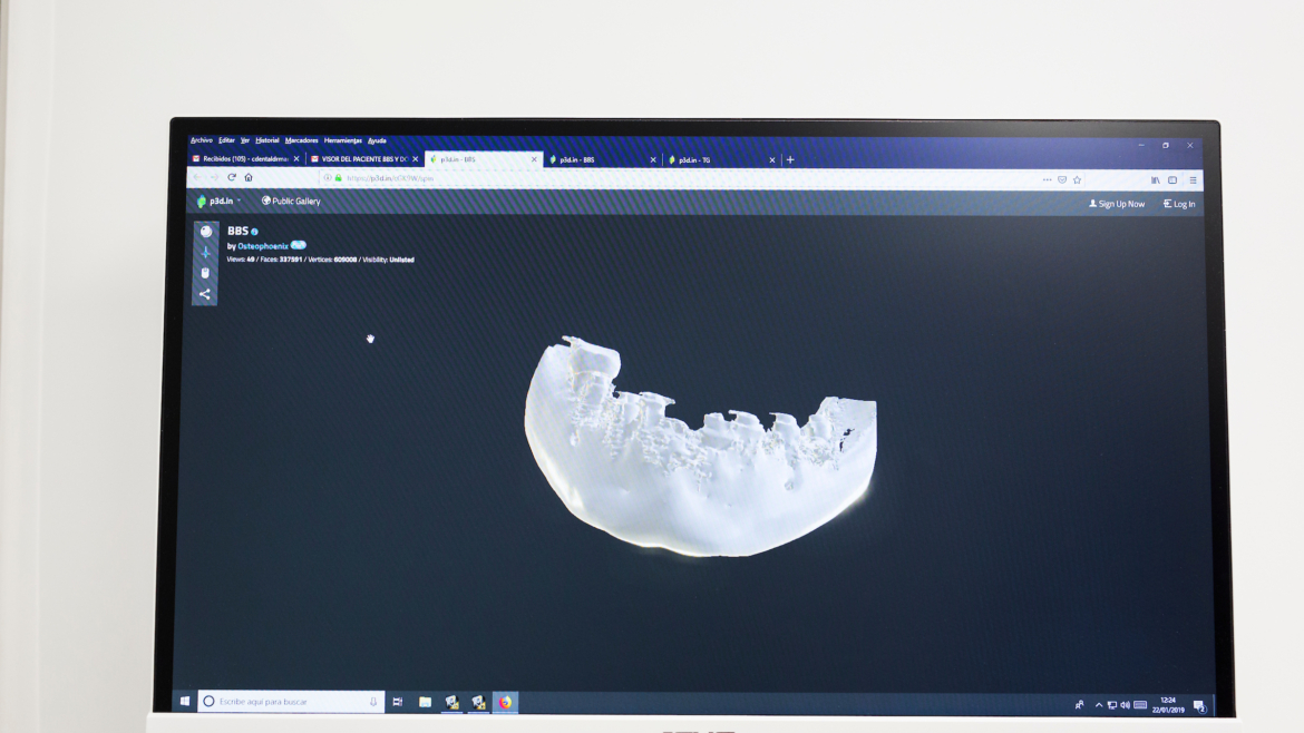 Regeneración ósea en periodontitis avanzada: ¿hay solución?