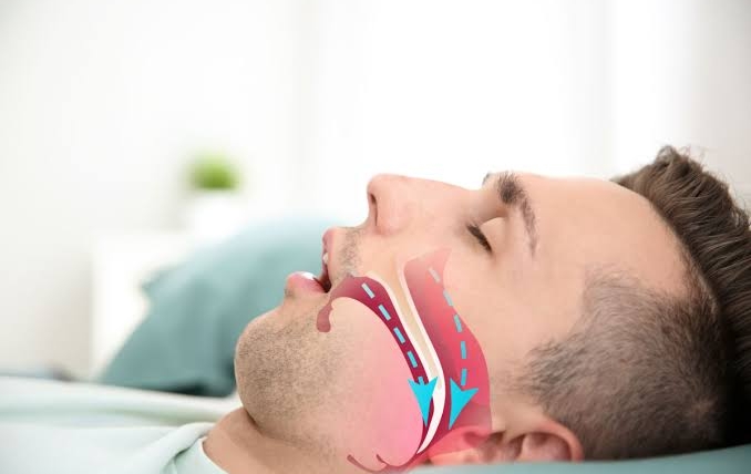7 señales de apnea del sueño y cómo tratarla