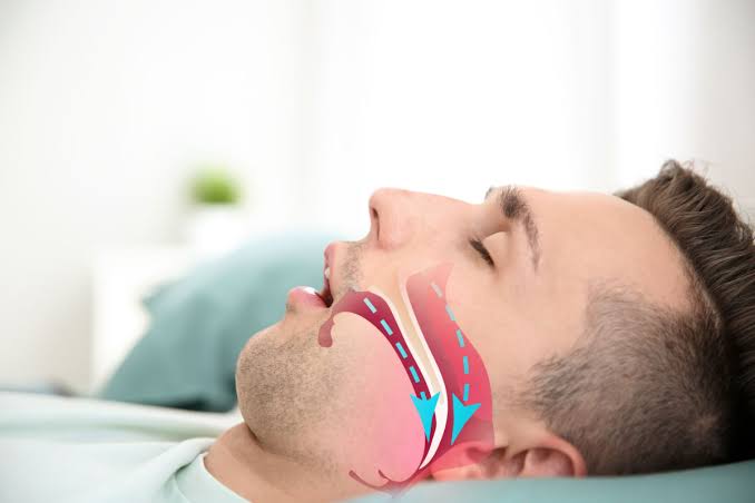 7 señales de apnea del sueño y cómo tratarla