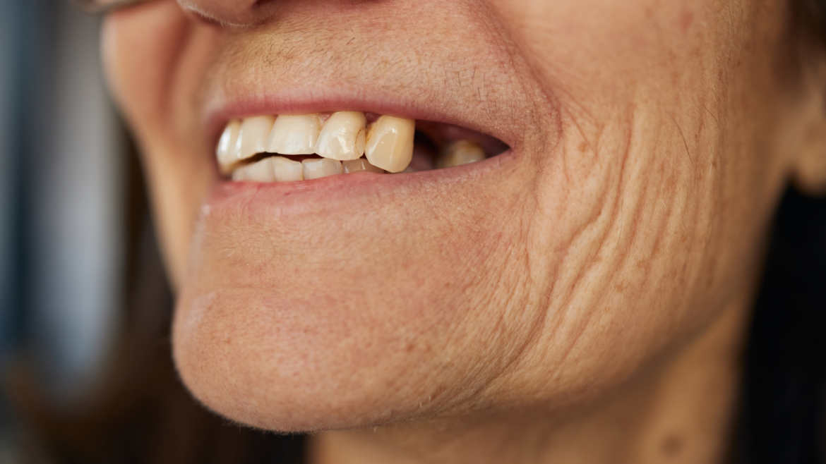 ¿Puede la pérdida dental afectar la forma del rostro?