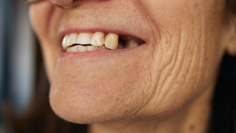 ¿Puede la pérdida dental afectar la forma del rostro?